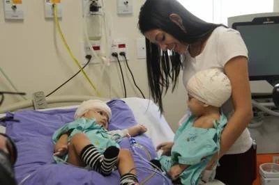 Mel e Lis: gêmeas siamesas se reencontraram pela primeira vez depois da cirurgia de separação no HCB, em 2019