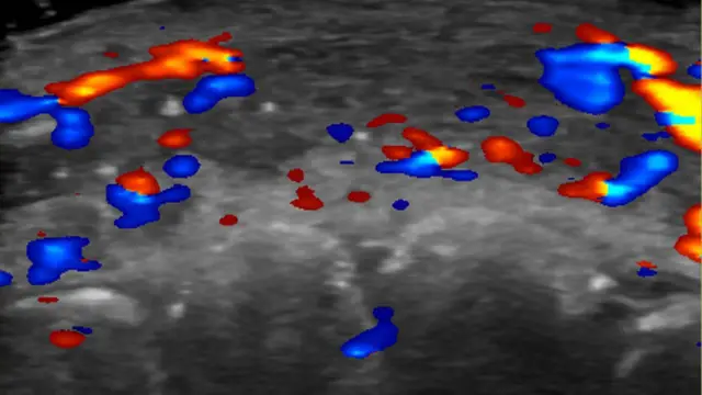 Ultrassom mostra uma área preta com vários pontos nas cores azul e vermelho 