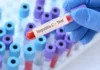 Mortalidade por hepatite viral atinge 1 a cada 5 pacientes com 80 anos no SUS